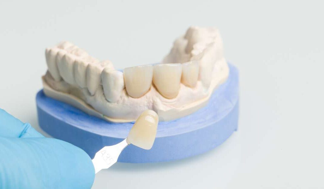 Carillas dentales: Todo lo que debes saber
