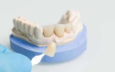 Carillas dentales: Todo lo que debes saber