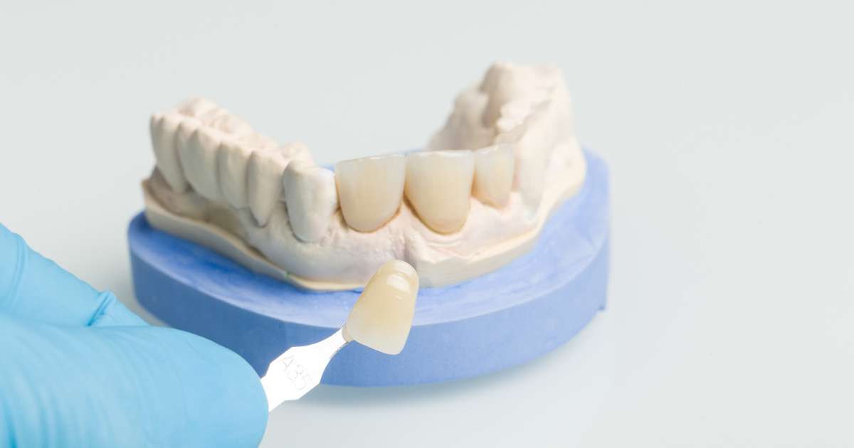 tipos-carillas-dentales
