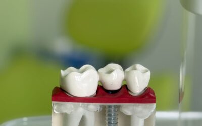 Implantes dentales: Guía completa y consejos