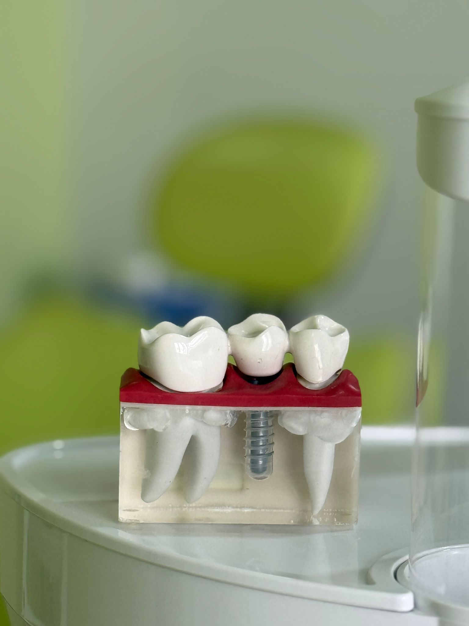 coronas-dentales Implantes dentales
