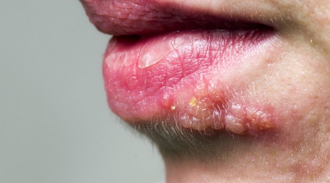 ¿Herpes, afta o hongos en la boca? Aprende a identificarlos
