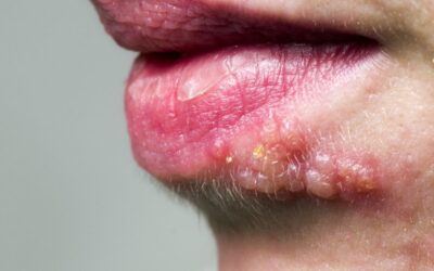 ¿Herpes, afta o hongos en la boca? Aprende a identificarlos