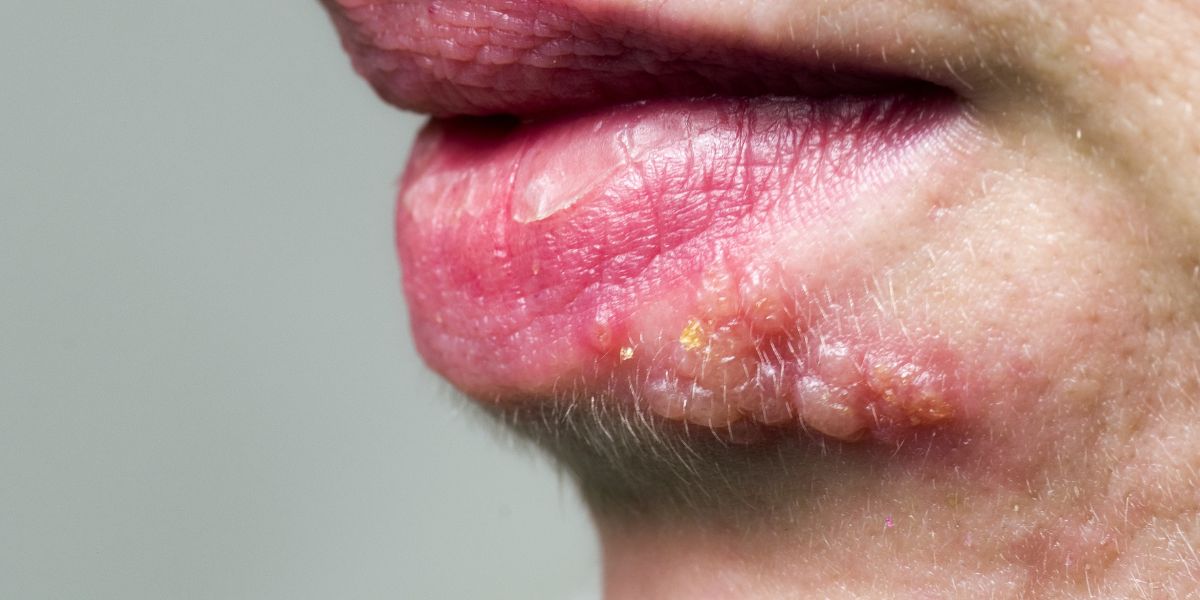 herpes-bucal-min Herpes en la boca