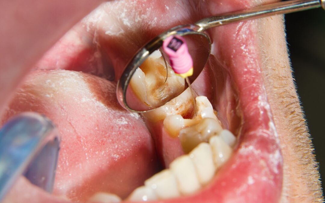 Si estás pensando en hacerte una endodoncia esta es tu guía