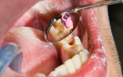 Si estás pensando en hacerte una endodoncia esta es tu guía
