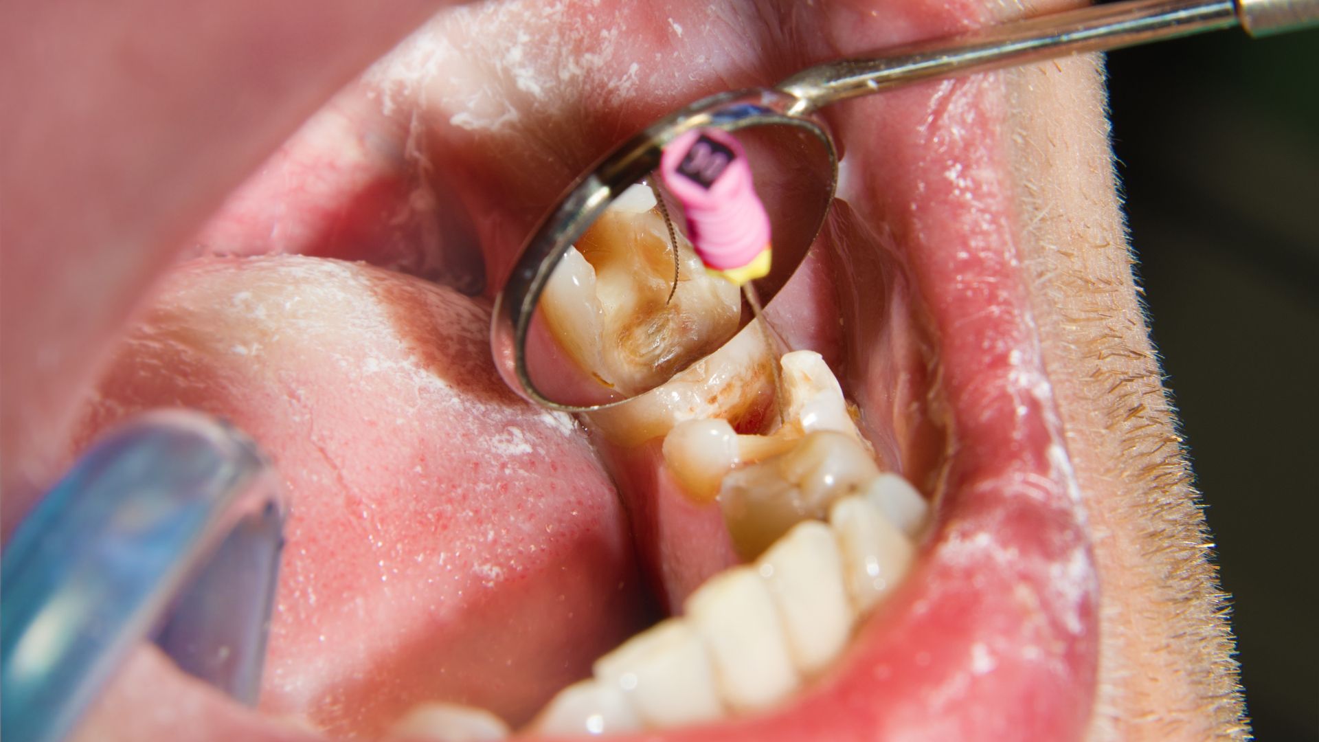 Endodoncia