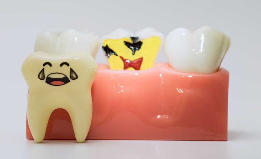 dentista-arcos-frontera-caries-dentales